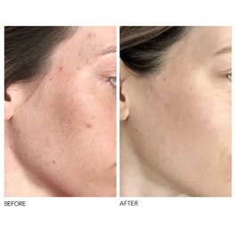 Alpha Beta® - Codzienny peeling o uniwersalnej formule