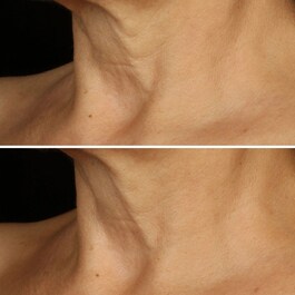 Smart Clinical Repair™ - Liftingujący krem do twarzy i szyi