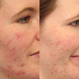 Clarifying Cleanser - Żel oczyszczający do twarzy
