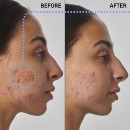 Serum na blizny, znamiona i zmarszczki Retinol 1% - Serum do twarzy