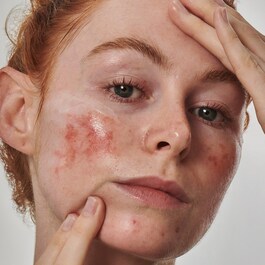 Anti-Redness Solution with Azelaic Acid 10% - Serum do twarzy