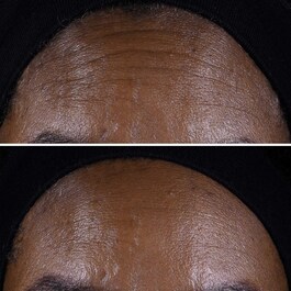 Smart Clinical Repair™ - Liftingujący krem do twarzy i szyi