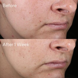 Rapid Age Spot Correcting - Serum do twarzy