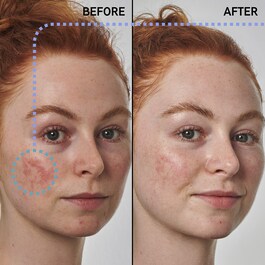 Anti-Redness Solution with Azelaic Acid 10% - Serum do twarzy
