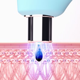 KIWI™ - urządzenie do próżniowego usuwania zaskórników z niebieskim światłem LED