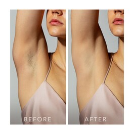 PEACH™ 2 - Urządzenie IPL do trwałego usuwania włosów z systemem Skin Cooling