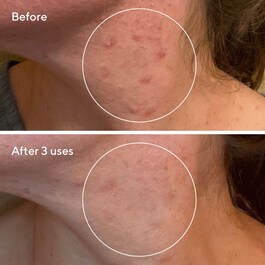 Rapid Relief Sulfur Mask - Oczyszczająca maska do twarzy z siarką i glinką