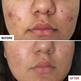 Centella Acne Care - Fluid łagodzący