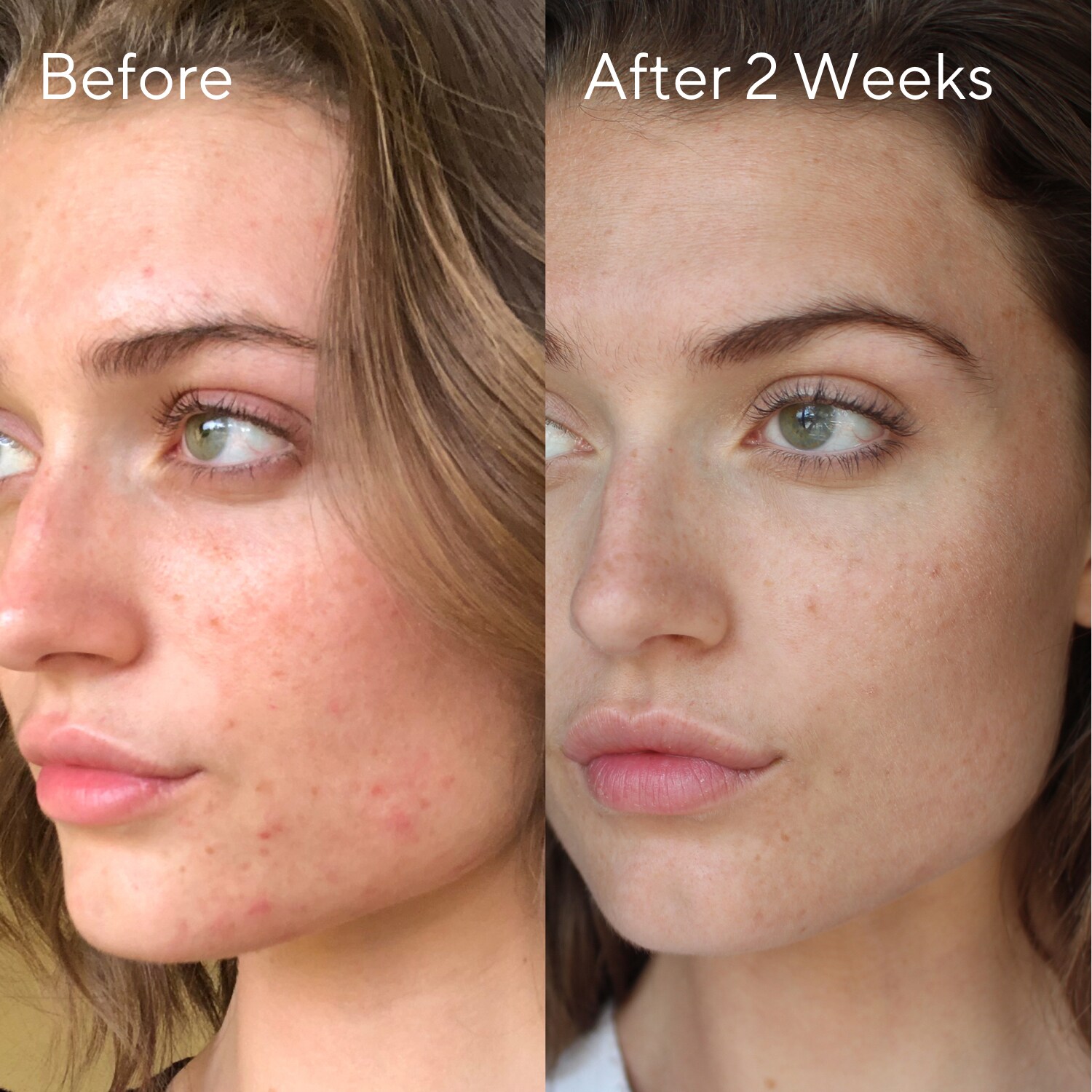 InvisiScar Resurfacing Treatment Kuracja na blizny potrądzikowe i